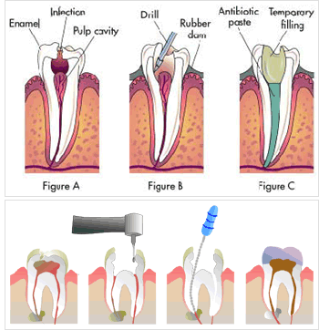 Root Canal Treatment Hyderabad